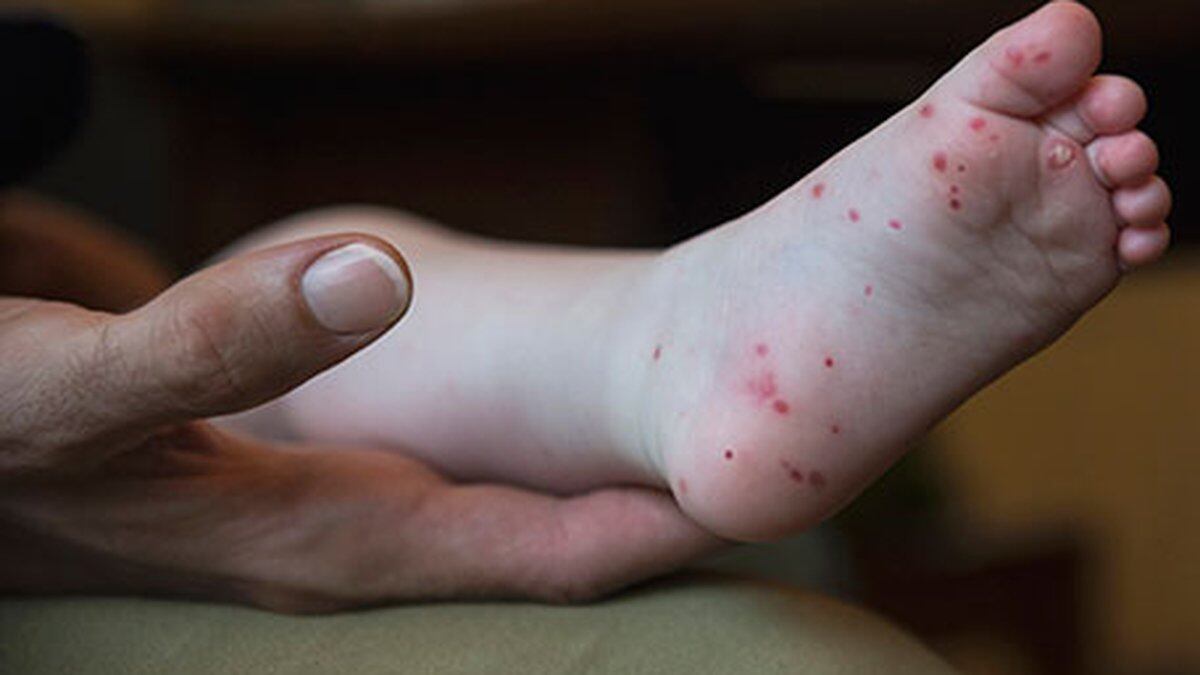 Hand Foot And Mouth Disease On The Rise In East Tennessee 8066