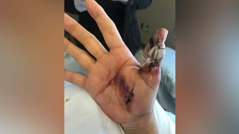 Woman claims she got flesh-eating bacteria at a Knoxville nail salon / Source: Jayne Sharp